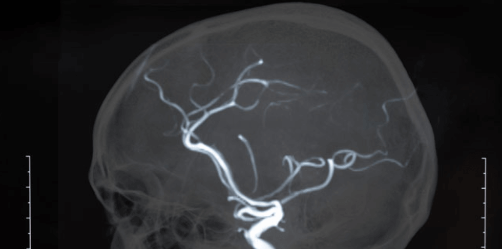 Spot a Stroke In 4 Easy Steps