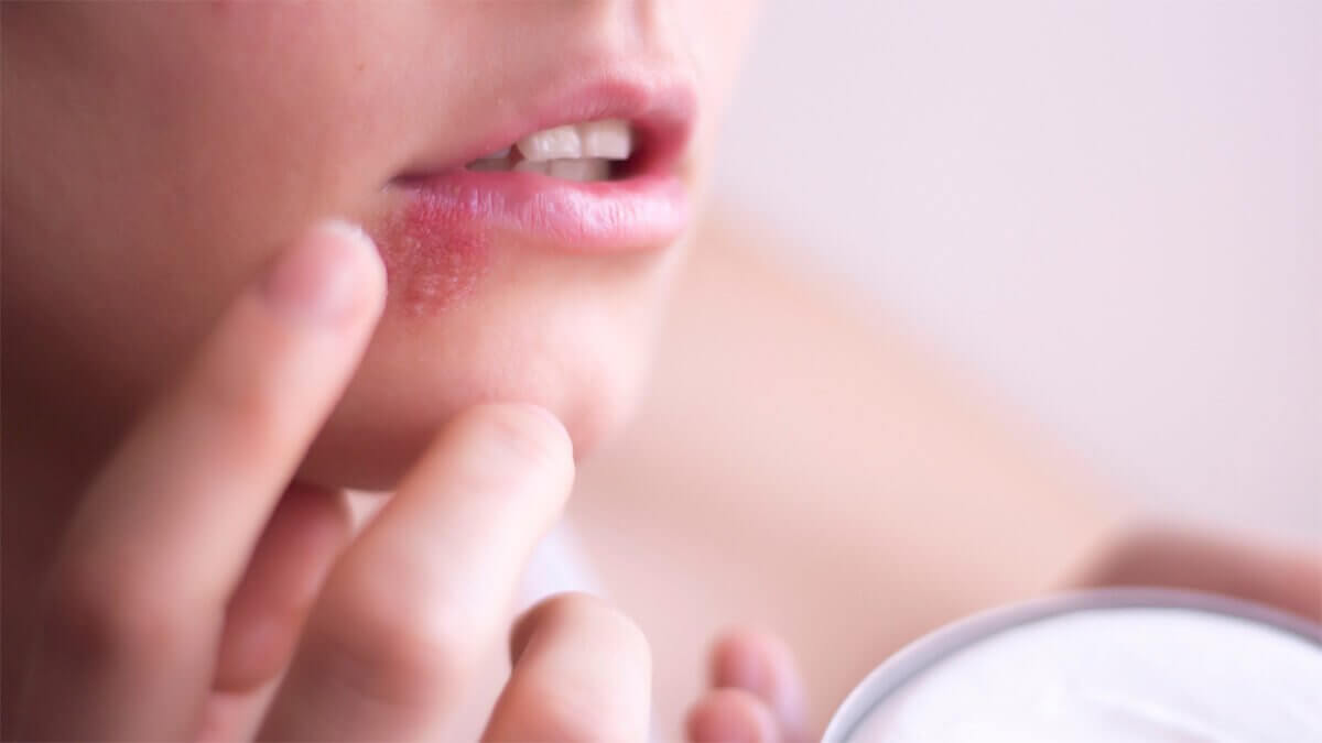 woman-with-cold-sore-symptoms woman-with-cold-sore-symptoms
